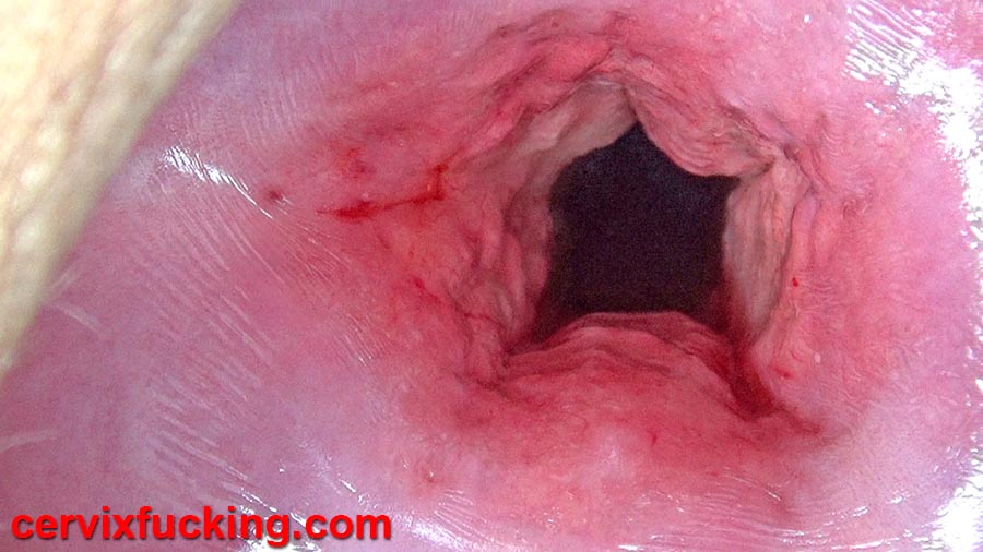 Cervix Penetration Dilation | Uterus Stretching